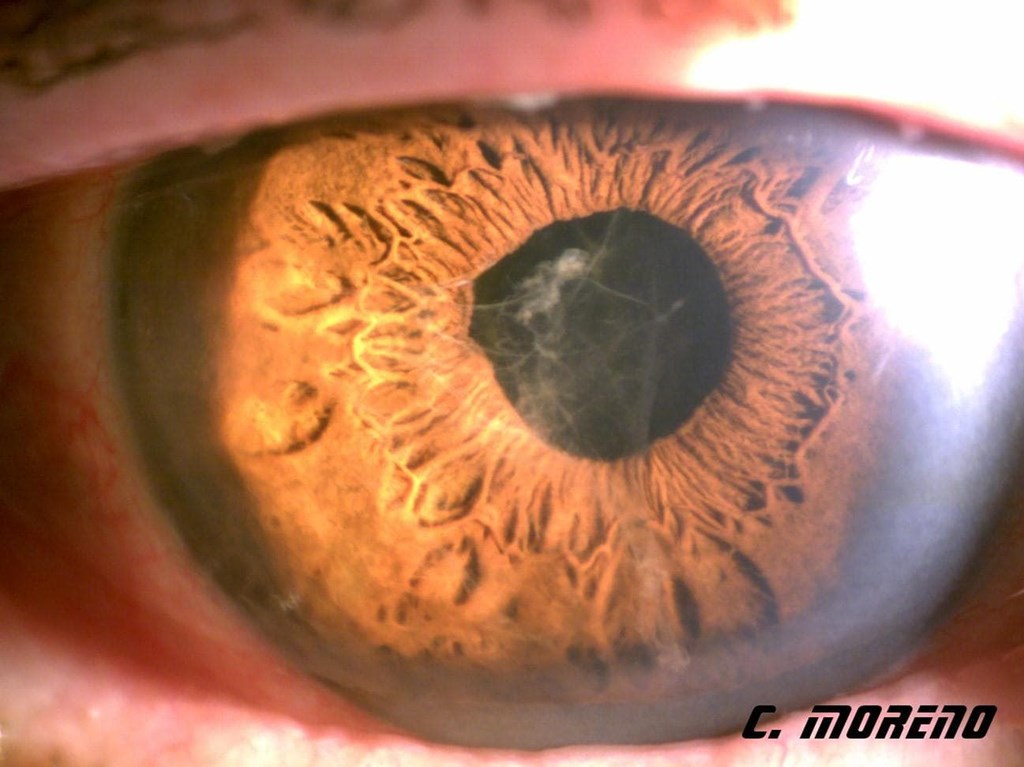 MEMBRANA INFLAMATORIA POSTCIRUGÍA DE CATARATA